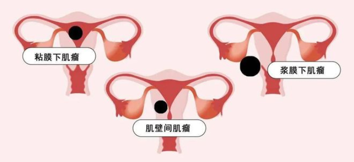 子宫腺肌病的医学伦理学:哪些女性容易患子宫肌瘤？