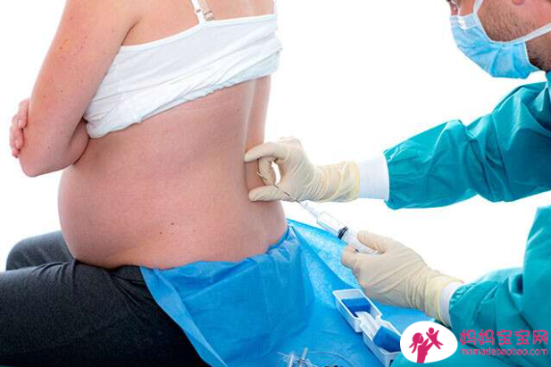 所有你需要知道的关于在分娩期间选择硬膜外麻醉