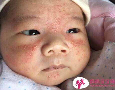 常见婴儿皮肤问题