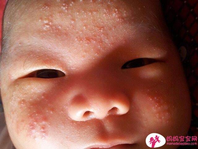 常见婴儿皮肤问题