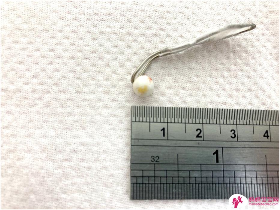 4歲男童調皮將bb彈塞入耳內，醫師用「回紋針」拆彈！