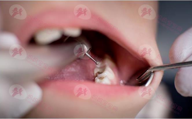 蛀牙怎么办？医生告诉你常见的5种蛀牙症状以及如何预防