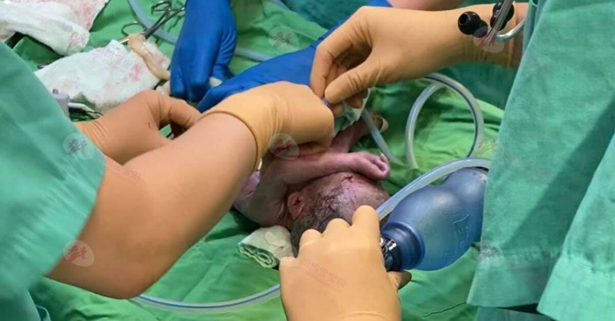 孕妇生产出动30名医护，成功救回全身发紫宝宝！生产，比你想的更危险！