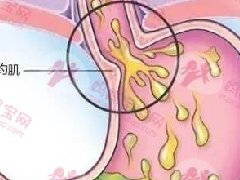 关于新生儿Reflux（胃食管返流）
