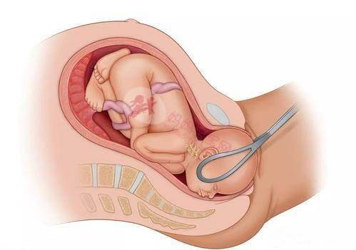 分娩方式影响宝宝的性格气质 这6种分娩方式孕妈必须知道