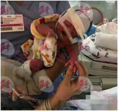 35周羊水早破，子痫并发症，早产双胞胎姐姐4.2斤，妹妹4斤