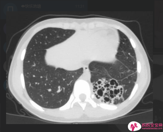 这些危险因子恐致新生儿呼吸阵喘 剖腹产也是其中之一