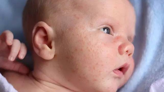 幼儿急疹（玫瑰疹）的症状和护理