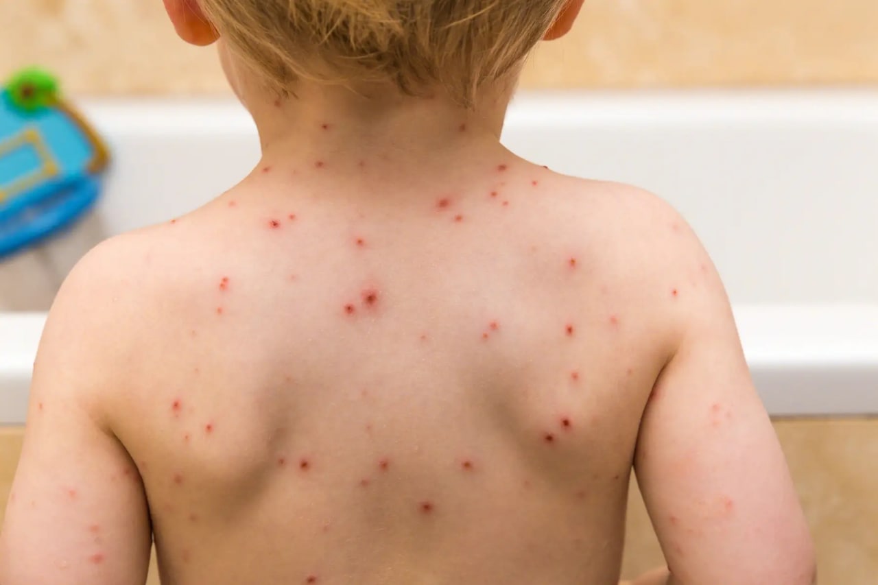 幼儿急疹（玫瑰疹）的症状和护理