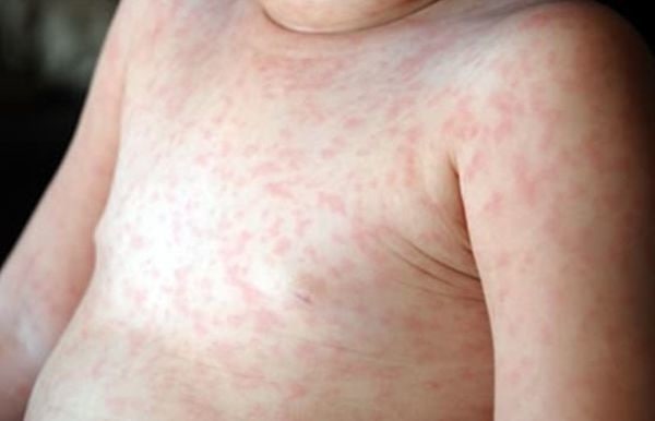 几种常见婴幼儿疹子!(特别关注婴幼儿各种疹子)?