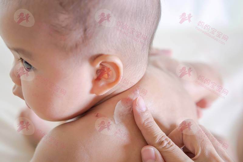 宝宝湿疹的用药护理经验
