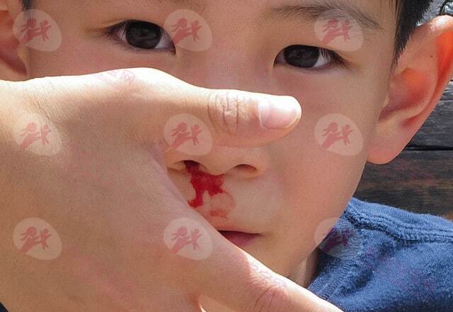 抬头止鼻血不靠谱！宝宝流鼻血的正确处理方法