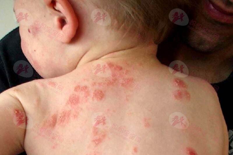 宝宝湿疹的诊断、护理与预防