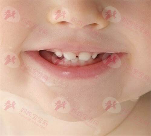 损害宝宝牙齿有哪些坏习惯