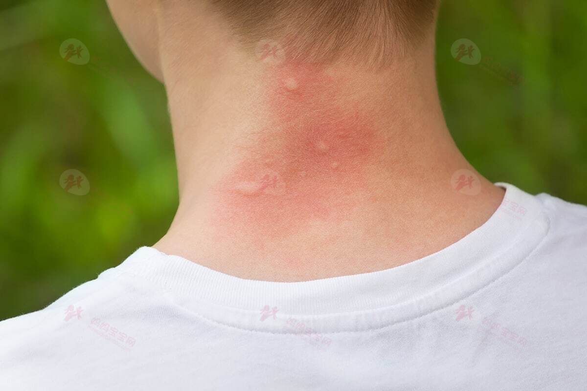 被蚊虫咬了常见症状都有哪些？爸妈应该怎么办？
