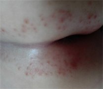 宝宝尿布疹护理 90%妈妈仍然不会（增加换尿布次数）