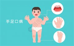 手足口病高发期 90%宝宝都中招了（注意饮食卫生）