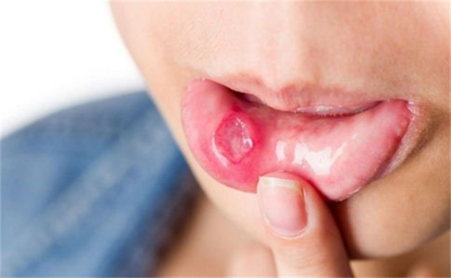 小孩子口腔溃疡是什么原因引起的