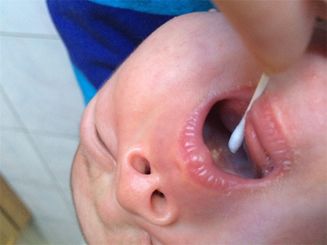小孩子口腔溃疡是什么原因引起的