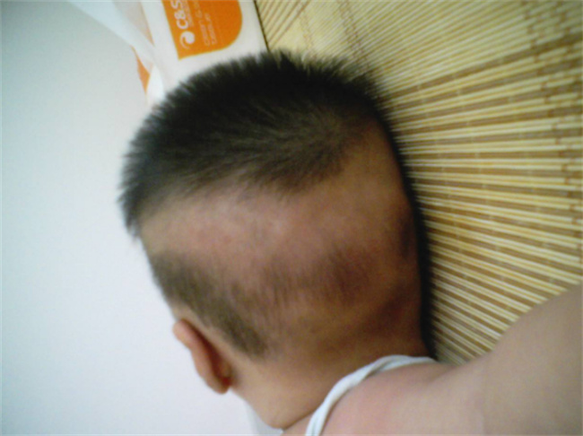 宝宝后脑勺一圈没有头发是怎么回事
