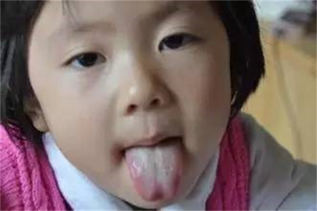 孩子舌苔厚是怎么回事 应该怎么办