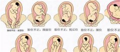 胎位不正应该怎么办（根据怀孕时间的不同有所差异）