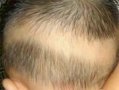 孩子的头发又黄又少 是缺乏哪些营养（维生素）