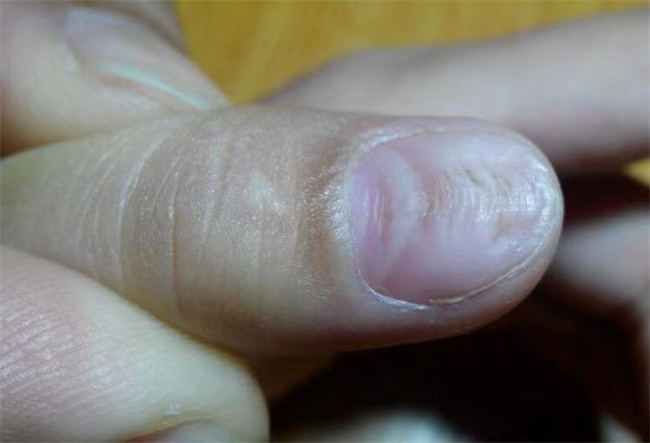 手指甲上有竖纹是缺少哪种微量元素