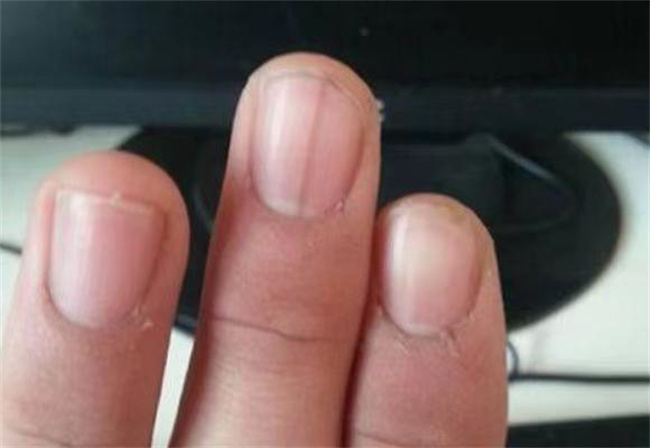 手指甲上有竖纹是缺少哪种微量元素