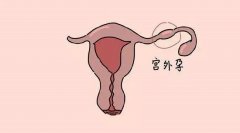宫外孕是什么原因引起的（输卵管炎或子宫肌瘤）