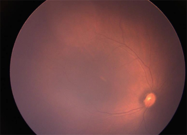 早产儿视网膜病变都有哪些症状
