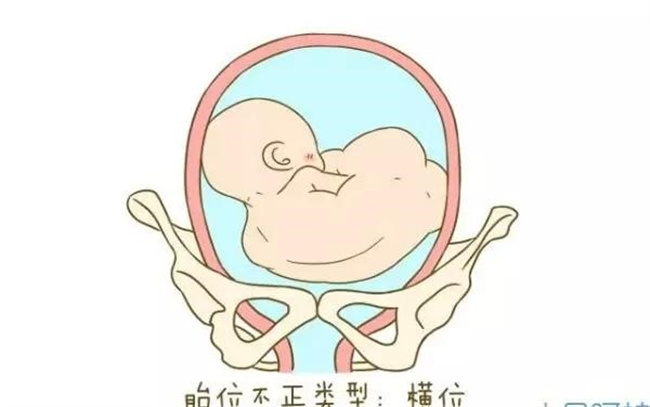 胎位不正孕妇需要注意哪些事项（定期产检，按照医生的指导操作，保持良好的