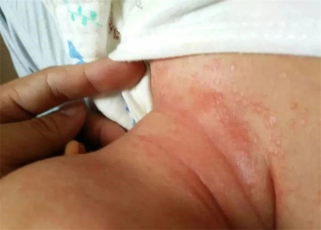 婴儿脖子下面容易出红疹子 应该怎么处理（根据病因选择合适的方法）