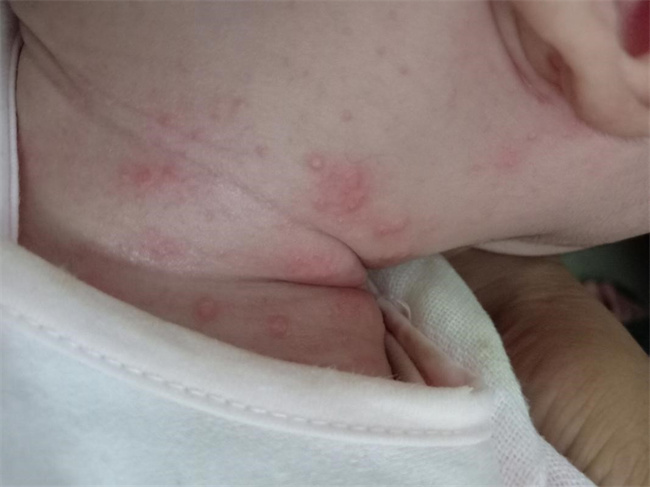 婴儿脖子下面容易出红疹子 应该怎么处理（根据病因选择合适的方法）