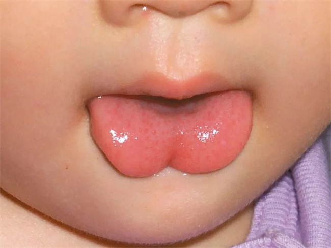 婴儿有很厚的舌苔是怎么回事（积食）