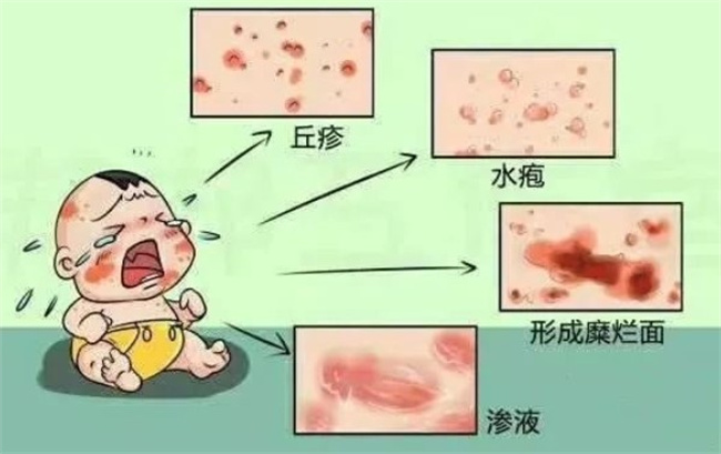宝宝几种不同症状皮炎的护理措施