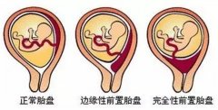 孕妈妈胎盘异常带来哪些不良后果（胎儿畸形发育等）