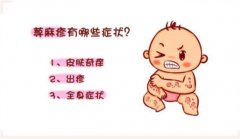 小儿荨麻疹急性和慢性的用药方法及偏方（口服药物或擦拭身体）