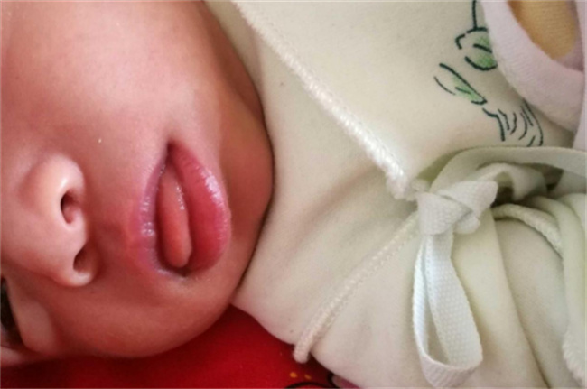 新生儿嘴唇起泡的原因有哪些（缺水、炎症）