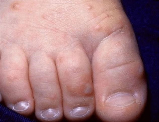 湿疹和手足口病之间的区别有哪些（发病人群，季节症状，治疗方面）