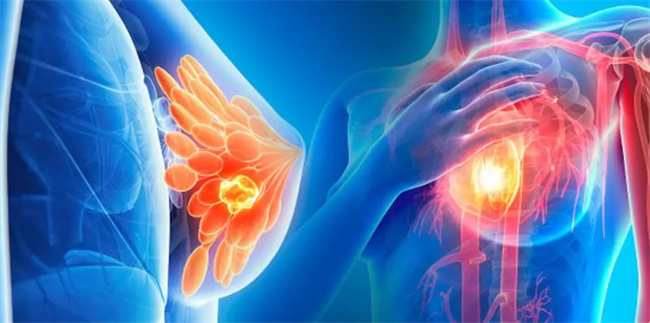 乳腺癌早期有哪些症状