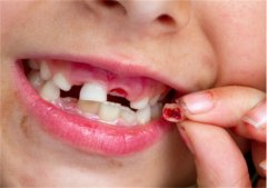 孩子换牙期需要注意哪些事项