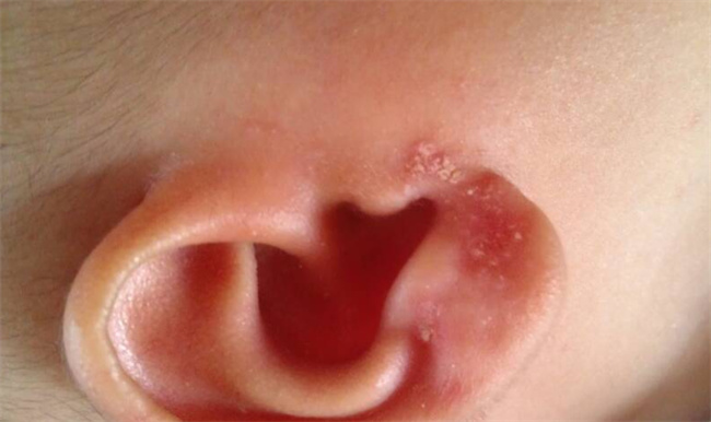 孩子耳内湿疹是怎么回事