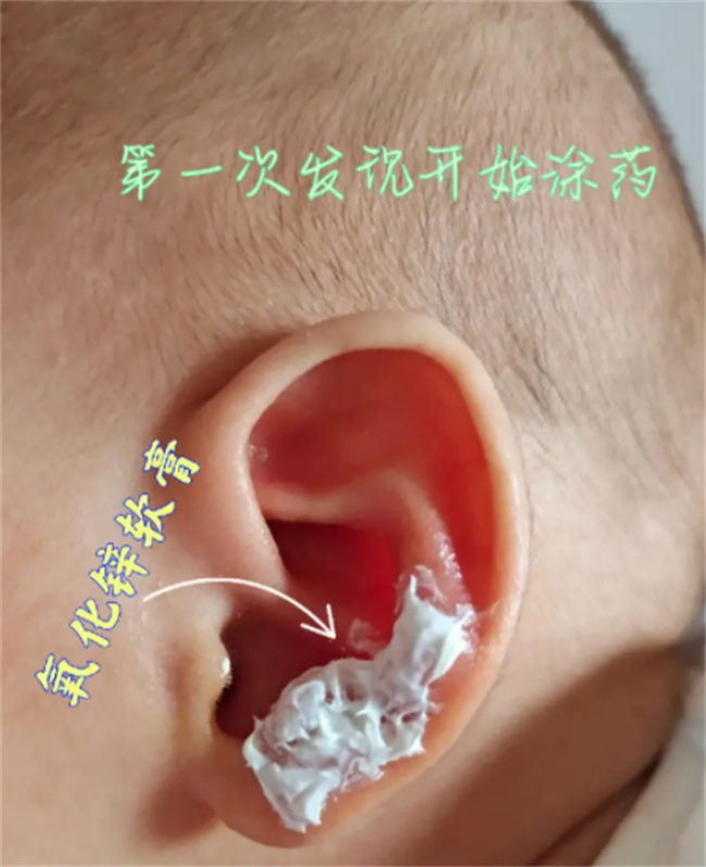 孩子耳内湿疹是怎么回事