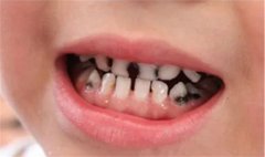 什么是乳牙龋齿