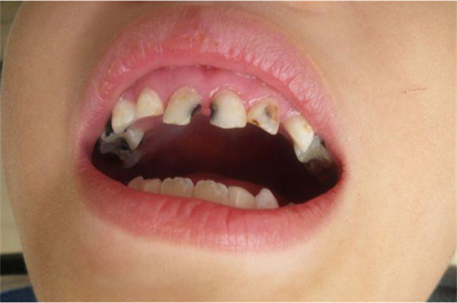 什么是乳牙龋齿