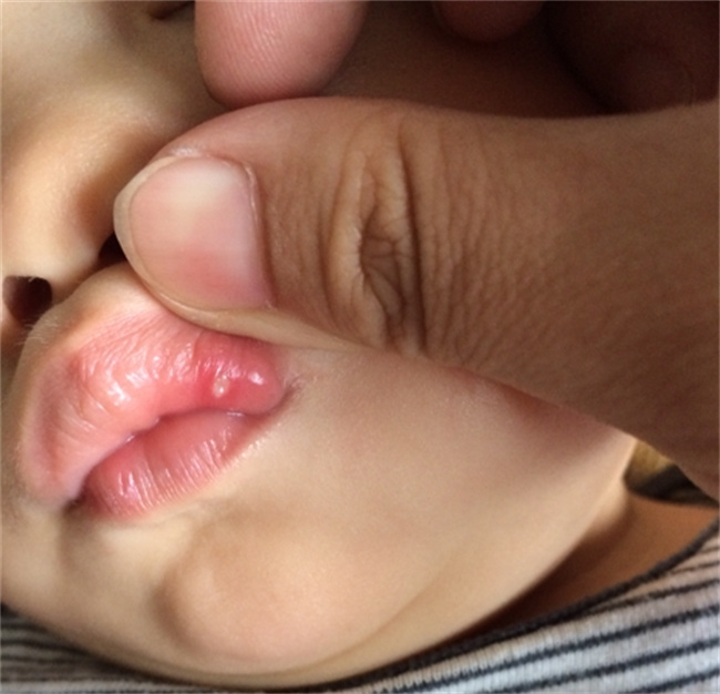 婴儿口腔溃疡应该怎么办