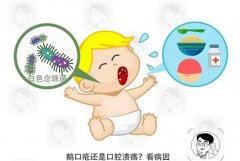 怎样预防婴儿口腔溃疡