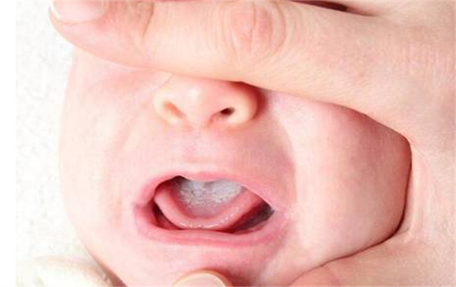 婴儿舌苔厚白应该怎么处理