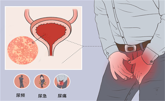 尿道炎有哪些症状